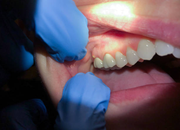 Best Emergency Wisdom Teeth Removal in Huntington, WV